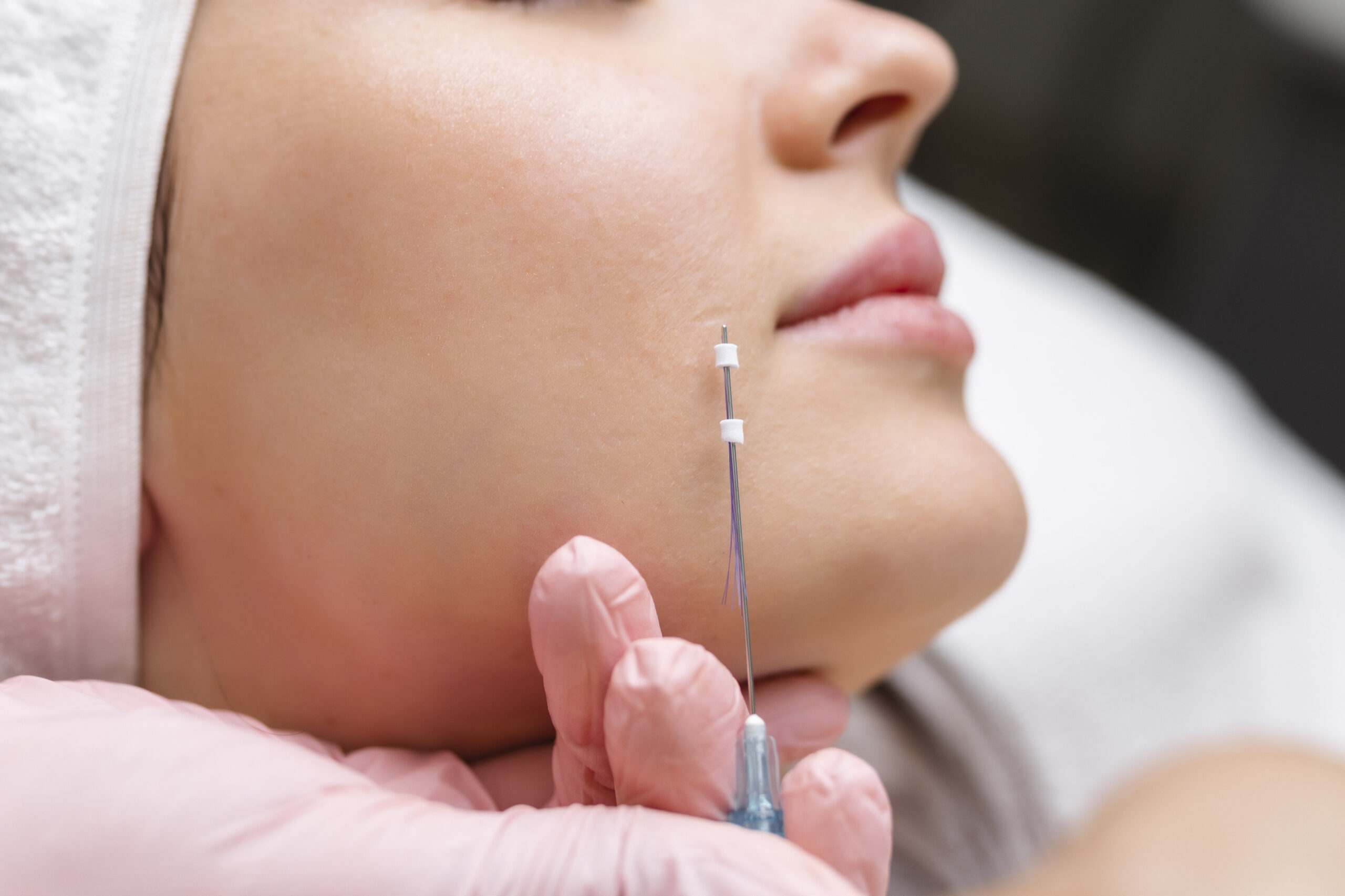 face lifting pdo suture operation innovative technique new thread lift cosmetologist preparing